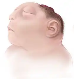 Illustration from the Centers for Disease Control and Prevention of Anencephaly