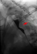 Aberrant subclavian artery seen at swallowing study: impression of the esophagus from behind.