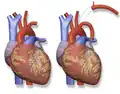Blalock–Thomas–Taussig Shunt – left subclavian artery to left pulmonary artery.