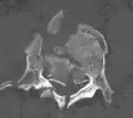 A burst fracture of L4 as seen on CT