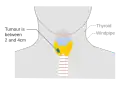 Stage T2 thyroid cancer