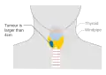 Stage T3 thyroid cancer