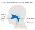 Stage T4 nasopharyngeal cancer