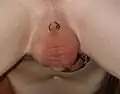 Guiche piercing (in foreground) with single captive bead ring