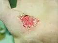 17 hours after injury