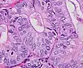 Nuclear grade 1: Oval, mildly enlarged nucleus with evenly distributed chromatin.[64]