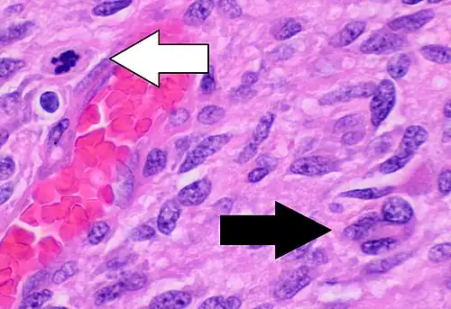 Histopathology of glioblastoma, showing high grade astrocytoma features of marked nuclear pleomorphism, multiple mitoses (one at white arrow) and multinucleated cells (one at black arrow), with cells having a patternless arrangement in a pink fibrillary background on H&E stain