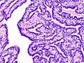 Histopathology of intraductal papilloma of the breast by excisional biopsy. Hematoxylin and eosin stain.