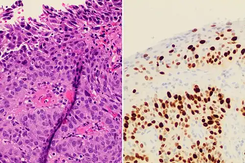 Invasive cervical squamous cell carcinoma on H&E histopathology and Ki-67 immunohistochemistry. The latter correlates well with the degree and level of dysplasia.[76]