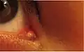 Small white lesion on lacrimal caruncle, most likely a cyst