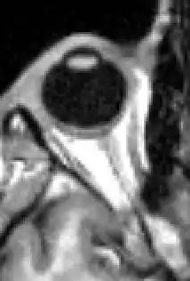 MRI scan of human eye showing lens