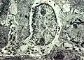 Melanocyte with melanin granules in dendrite. PMID 6200593