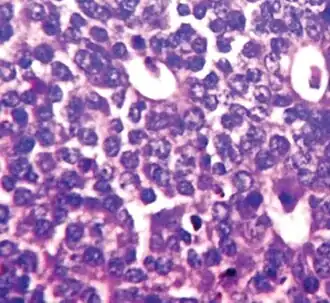 Ductal carcinoma with mild nuclear pleomorphism