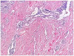 Micrograph of promontory sign in Kaposi's sarcoma in patch stage. Dilated irregular vascular channels surround a pre-existing vessel.[16]