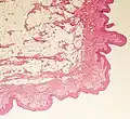 Intermediate magnification, showing mature lipocytes with absence of capsule.