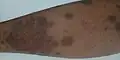 Psoriasis on a leg