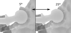 Acetabular anteversion is normally between 5 and 25°.[20] An anteversion below or above this range increases the risk of dislocation.[20] There is an intra-individual variability in this method because the pelvis may be tilted in various degrees in relation to the transverse plane.[20]