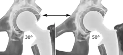 Acetabular inclination is normally between 30 and 50°.[104] A larger angle increases the risk of dislocation.[20]