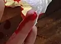 Fresh incisional wound on the fingertip of the left ring finger