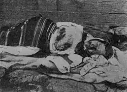WWI Elder Serbian Peasant Woman Civilian, mutilated by Germans and Austrians