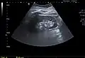 A very small (8&nbsp;mm) simple renal cyst