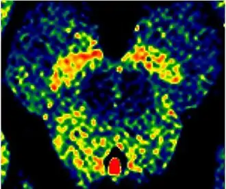Enhanced Neuromelanin MRI with Color images (RGB) showing Substantia nigra pars compacta