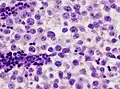 Histopathological image of metastatic seminoma in the inguinal lymph node. At higher magnification. Hematoxylin & eosin stain.