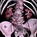 Volume rendering of a CT scan of the lumbar vertebral column, showing butterfly vertebrae at several levels, most typically in L1.