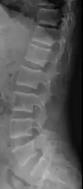 X-ray of a subtle "rugger jersey spine" due to sclerotic bands adjacent to the vertebral endplates.[18]